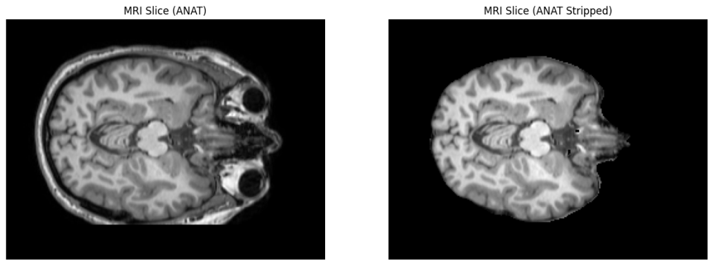 MRI skull stripping before and after