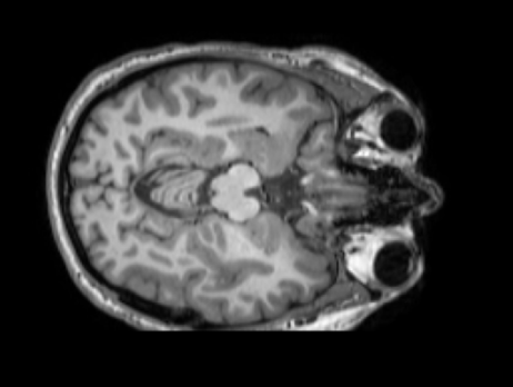 Brain MRI before skull stripping