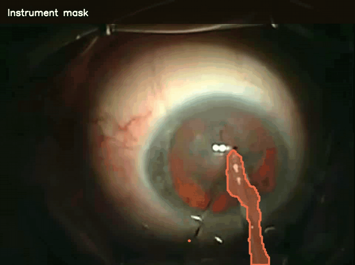 CataractFM surgical instrument segmentation throughout a procedure