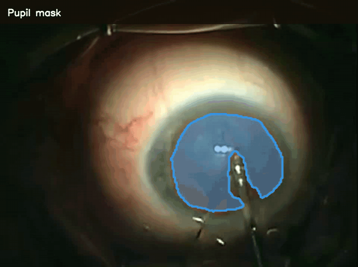 CataractFM pupil segmentation throughout a surgical procedure