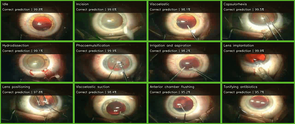 CataractFM predictions across 12 surgical phases